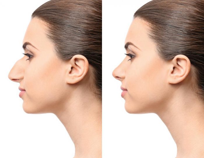 Nose Surgery Houston, TX | Rhinoplasty | Cosmetic Surgeon