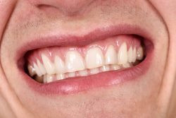 What Causes Swollen Gums? | How To Get Rid Of Swollen Gums?