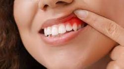 What is Gum Disease Treatment | Signs of Gum Disease Symptoms