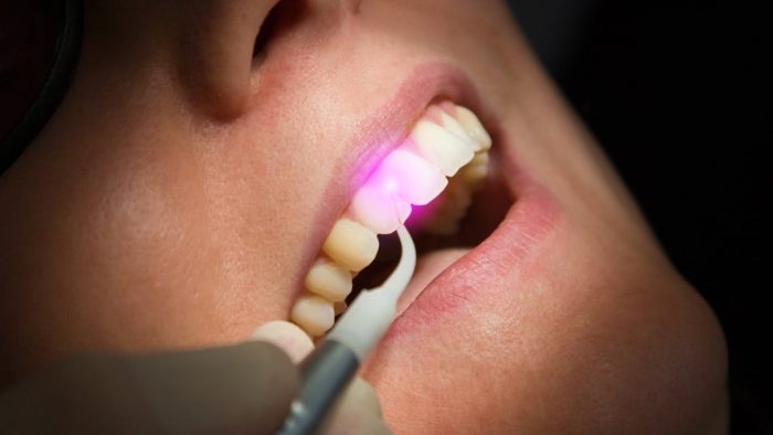 Laser Dentistry – Advanced Laser Dentistry Treatments For Cavities