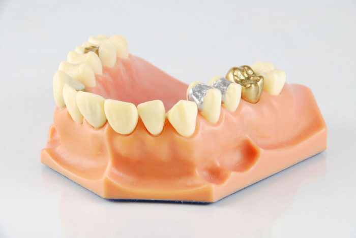 Why You Need a Porcelain Crown | Dental Crowns Houston, TX