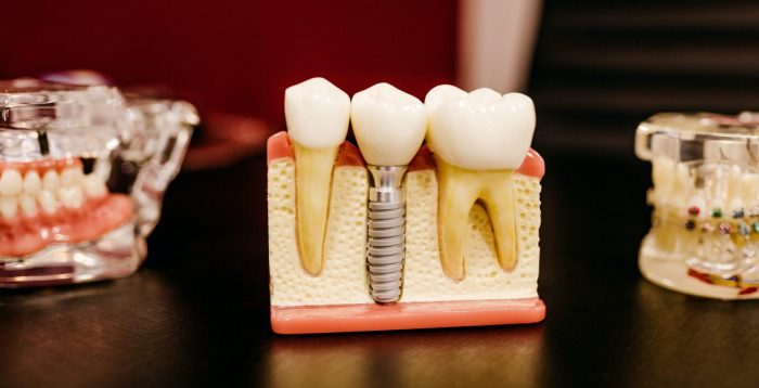 How to Fix a Chipped Tooth | URBN Dental