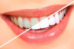 Professional Teeth Whitening Uptown Houston | Cosmetic Dentist