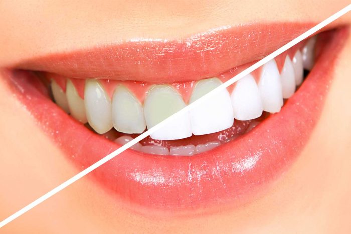 Professional Teeth Whitening Uptown Houston | Cosmetic Dentist