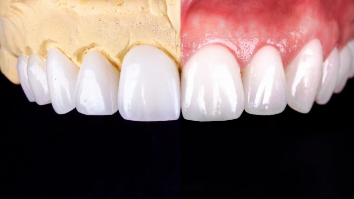 Why Do I Need Dental Veneers? | Prepping Your Teeth for Dental Veneers