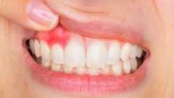 What Causes Tooth Infection?