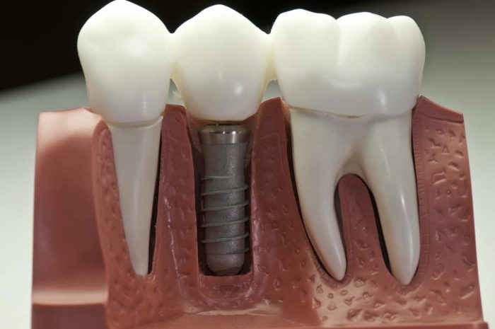Dental Implants Near Me | Dental Implant Procedure | Implant Dental surgeon