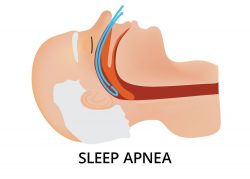 Sleep Apnea Dentist In Uptown TX