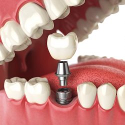 Best Dental Implants in Houston TX