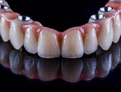 Full Arch Dental Implants Cost in Houston, TX