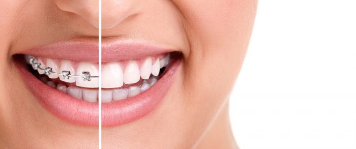 Invisalign Treatment Near Me