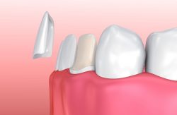 Why Do I Need Dental Veneers? | Teeth Prepped For Veneers