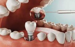 Best Dental Implants in Houston TX