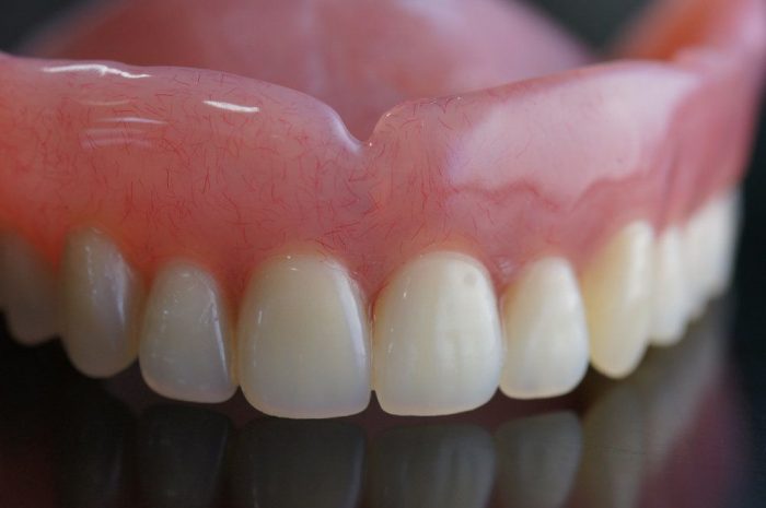 What are Inlays and Onlays? | Dental Inlays And Onlays Houston