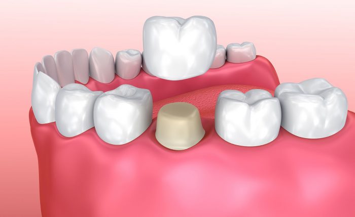 Periodontitis Treatment Houston | Stages of Periodontitis Symptoms