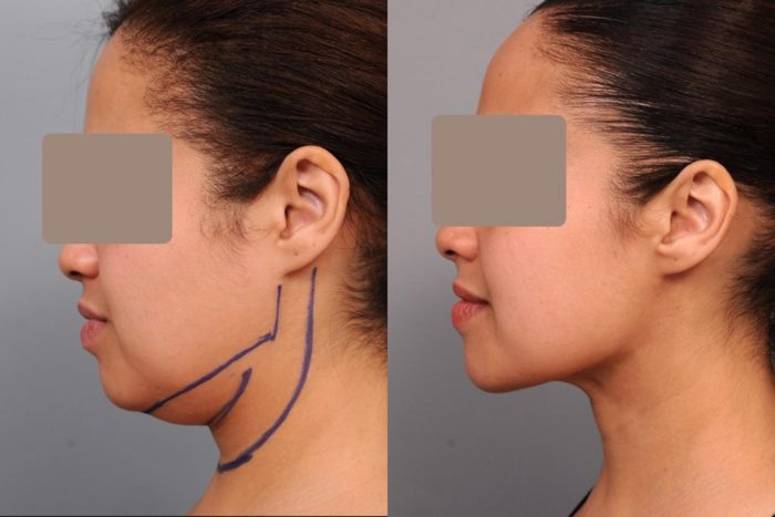 Benefits of Neck Liposuction