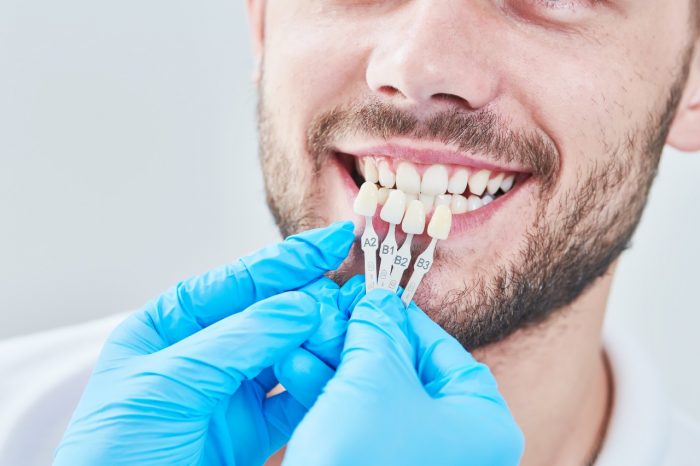 How much do teeth veneers cost?