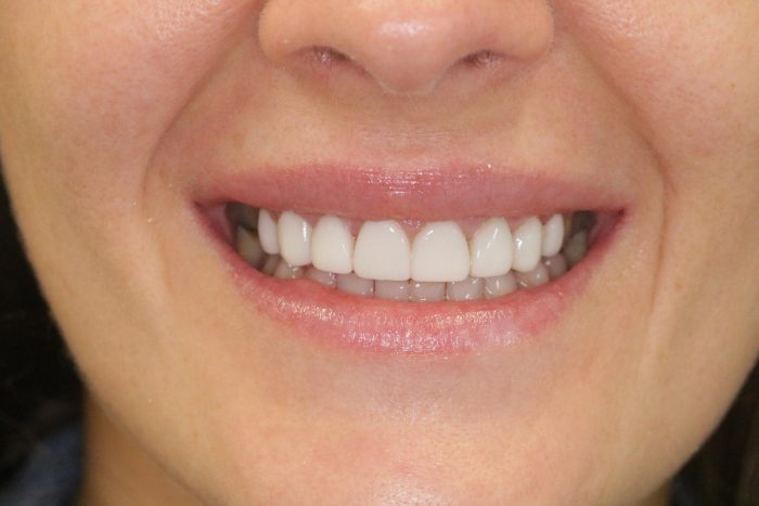 how much do porcelain veneers cost?