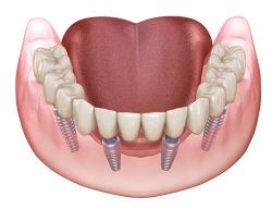 What Are Dental Implants for Dentures?