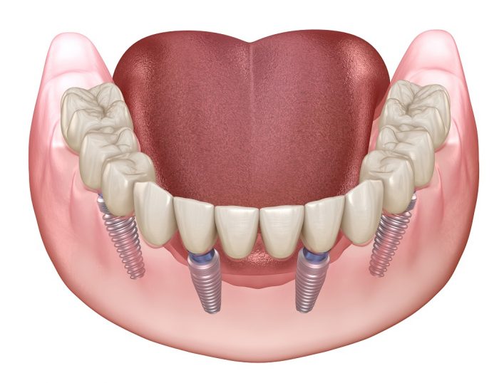 What Are Dental Implants for Dentures?