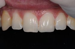 Fix Cavity on Front Tooth | Composite Front Tooth Cavity Filling or Bonding