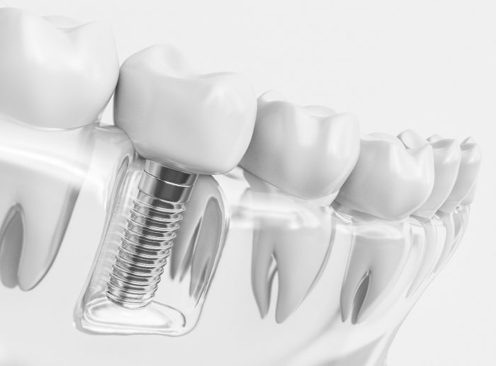 Affordable Dental Implants in Houston