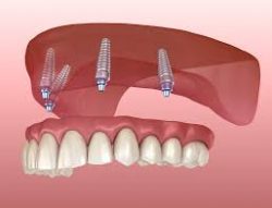 Different Types of Dental Implants