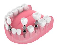 Different Types of Dental Implants