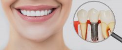 Affordable Dental Implants in Houston