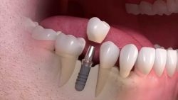 How much does a Tooth implant cost?