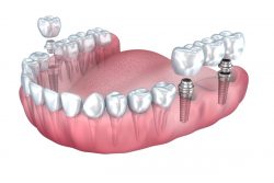 Average Cost of Dental Implants