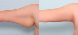 Arm Liposuction in Houston