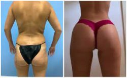 Fat Transfer to Buttocks Recovery
