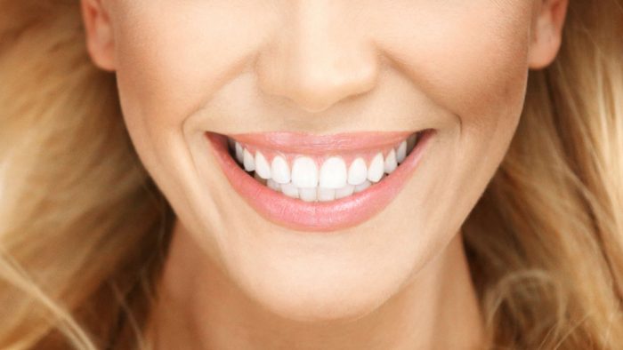 Minimal Prep Veneers in Aventura, FL