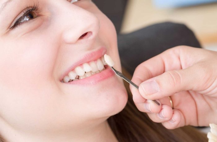 Things to Know Before Getting Veneers