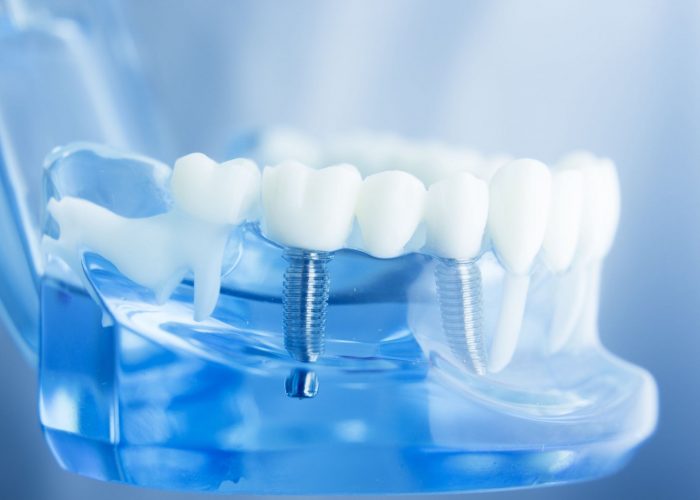 Best Dental Implants in Houston TX