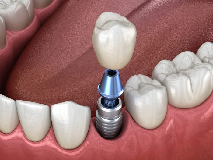 Best Implant Dentist in Houston TX