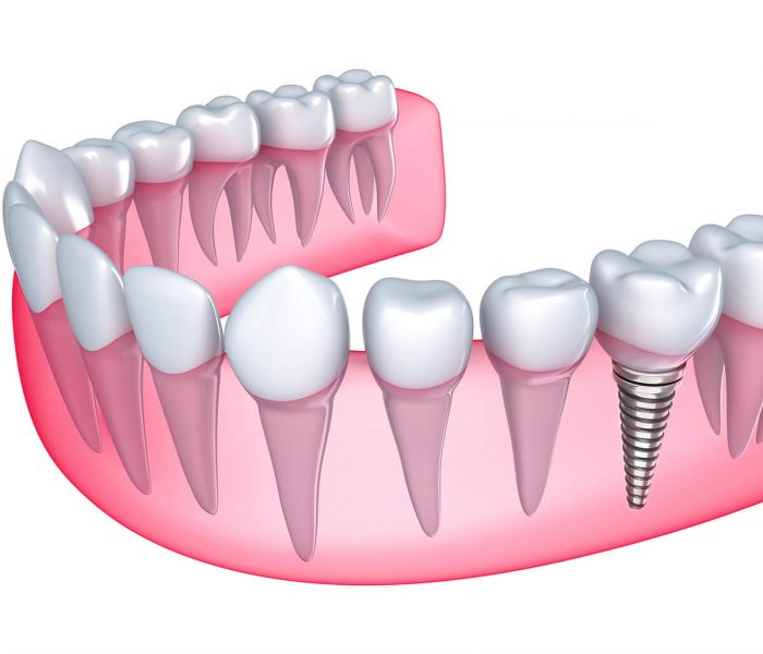 tooth crown before and after