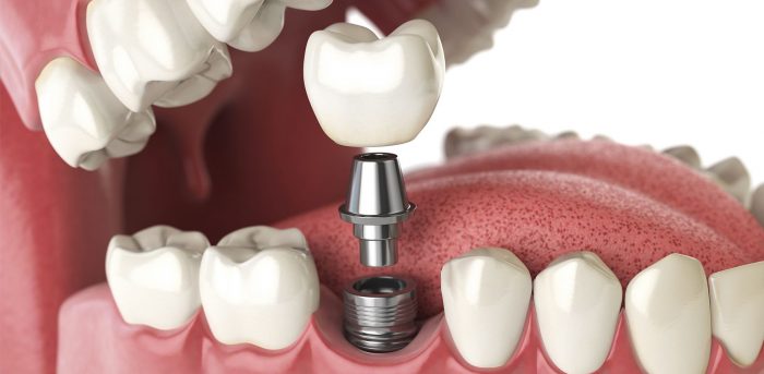 Dental Implants Houston, TX