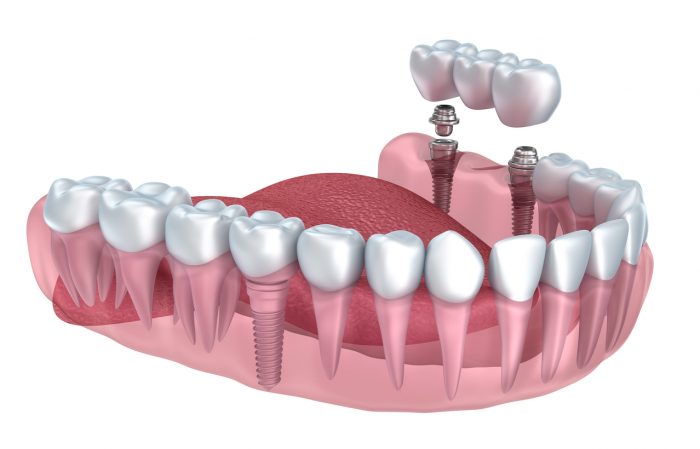 Different Types of Dental Implants