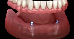 Affordable Dental Implants in Houston