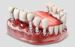 How Much Do Partial Dentures Cost?
