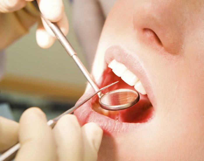 Emergency Dental Extraction in Sunny Isles