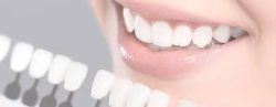 Dental Veneers in Houston, TX