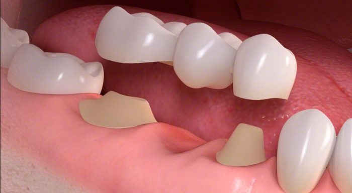 Porcelain Dental Bridge Procedure