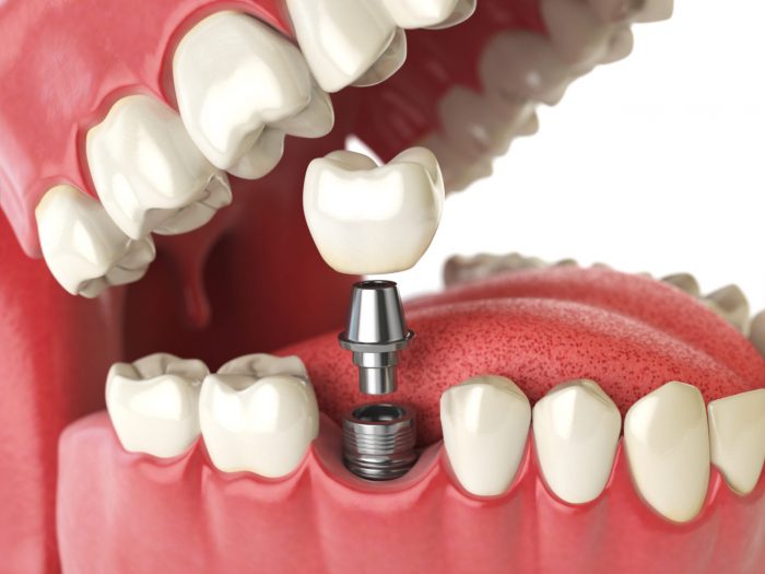 How Much Does A Dental Implant Cost For One Tooth?