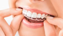 Does Mouth Guard Help Bruxism?