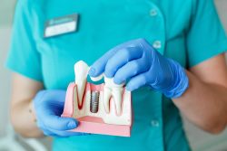 How to Find a Dental Implant Specialist – Dentist Houston TX