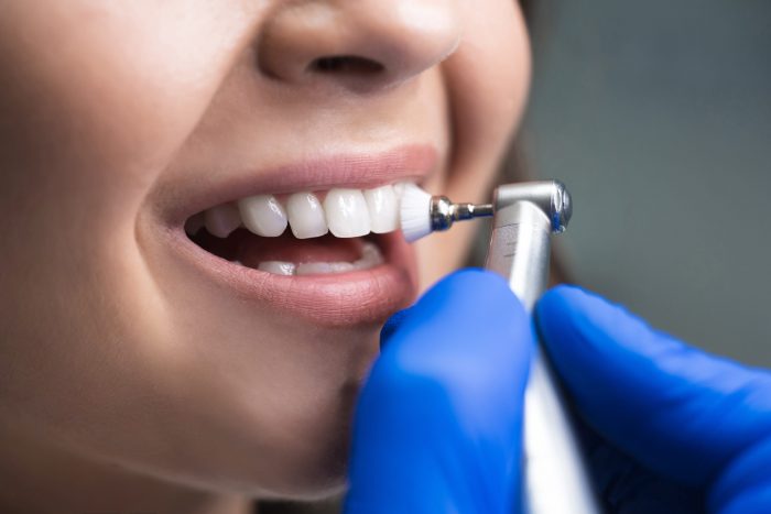 Dental Deep Cleaning Treatment Procedure