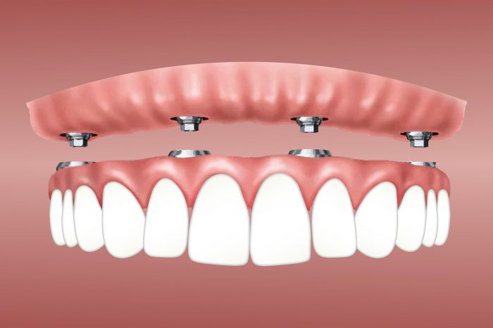 Affordable Dental Implants in Houston